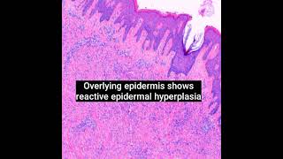 Histopathology of Cellular Dermatofibroma dermpath dermatopathology shorts [upl. by Akema]