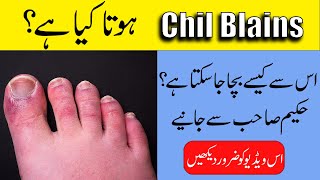 Chilblains Treatment  Swollen hands and fingers in winter  By Hakeem ObaidurRehman [upl. by Suchta327]