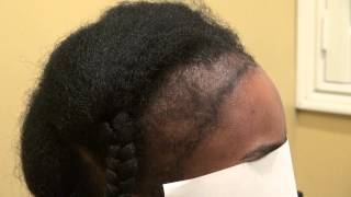 Black Woman Hair Loss Hairline Restoration Surgery Dr Diep wwwmhtacliniccom Bay Area CA [upl. by Llerdnad137]