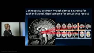 Hypothalamic Hamartoma Imaging Use in Diagnosis amp Management by Varina Boerwinkle [upl. by Carma974]