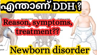 DDH Developmental dysplasia of hipcongenital dislocation of hip  Newborn babies  Malayalam [upl. by Hazaki]