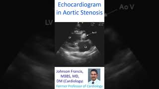 Echocardiogram in Aortic Stenosis [upl. by Amand506]