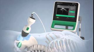 Verathon BladderScan Prime Portable Ultrasound Instrument [upl. by Koenraad]