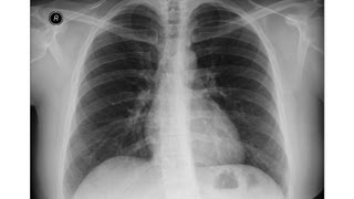 chest xray  Idiopathic Pulmonary Fibrosis [upl. by Nanji]