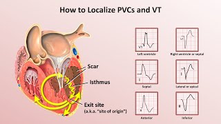 Advanced EKGs  Ventricular Tachycardia Classification amp Localization [upl. by Einiar901]