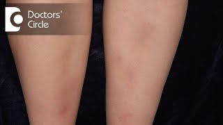 How to manage Lichen Planus present in the legs  Dr Rajdeep Mysore [upl. by Tizes]