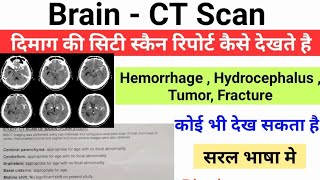 Brain  CT Scan रिपोर्ट देखना सीखे  दिमाक की सिटी स्कैन रिपोर्ट कैसे देखते है [upl. by Ennybor812]