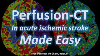 Perfusion CT made easy  everything you always wanted to know about PCT in acute ischemic stroke [upl. by Eelatsyrc33]