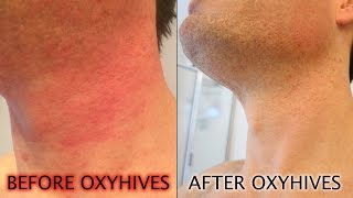 How To Get Rid Of Hives With The OxyHives Hives Treatment [upl. by Aihsemek]