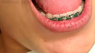 Flossing Braces With a Threader [upl. by Deane]