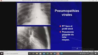 cours 14 pneumologique  pneumopathies virales [upl. by Burk]