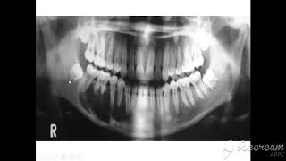 radiographic features of ameloblastoma [upl. by Sinclare3]