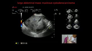 cistoadenocarcinoma mucinoso dellovaio destro [upl. by Frederick]