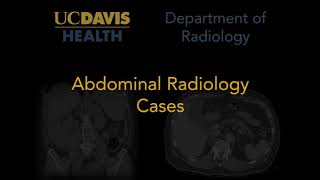 Fournier gangrene on ultrasound [upl. by Aneled560]