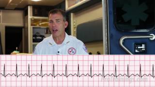 Supraventricular Tachycardia ECG Rhythm Interpretation [upl. by Addam389]