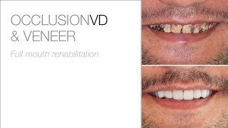 Full Mouth Rehabilitation with edelweiss VENEERs and OCCLUSIONVDs [upl. by Marva652]