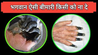 एक एसी खतरनाक बीमारी  Gangrene Symptoms and causes  gangrene kyu hota hai  Dr tarun [upl. by Esital764]