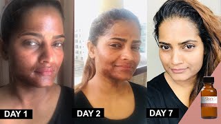 25 TCA Chemical Peel at home method and progress by Hina UrduHindi [upl. by Madella]