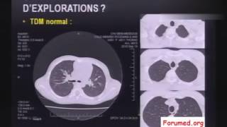 Cas Cliniques en images sur la fibrose pulmonaire idiopathique et pneumopathie [upl. by Dallon342]