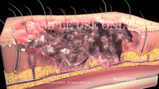 Burns Classification and Treatment [upl. by Ysiad613]