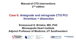 Case 6 Manual of CTO Interventions  OCT for thrombus and dissection [upl. by Annoyt]