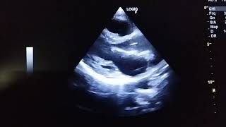 Acute myocarditis  2 weeks after the symptom onset amp on treatment [upl. by Brandy]