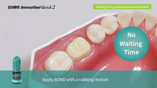 How to with UBQ 2 Sealing of A Prepared Abutment Tooth [upl. by Weyermann248]