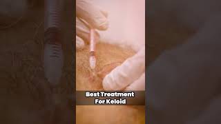 How to treat keloid scar  Keloid Removal Treatment at Skinaa Clinic viral shorts [upl. by Darill]