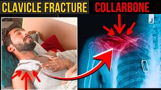 clavicle fracture  collarbone fracture  clavicle fracture natural healing [upl. by Firestone497]