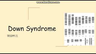 Trisomy 21 Down syn Genetics Pathology Clinical Symptoms and Diagnosis [upl. by Anaig264]