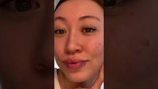 Blackheads Removal  Acne Treatment and Very Satisfying Satisfying Pimple pop blackheads [upl. by Audly]