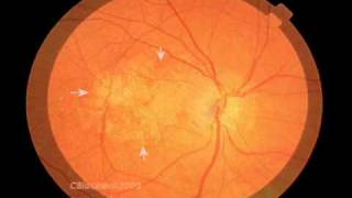 Macular Degeneration and the Aging Retina [upl. by Keiryt]