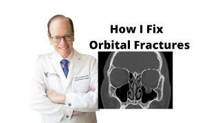 Orbital Fractures 101  Oculoplastic Surgeon Explains Orbital Fracture Surgery [upl. by Millie]