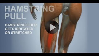 Common Sports Injuries Hamstring Pull [upl. by Eriuqs]