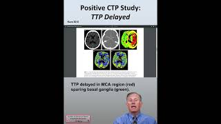 CT Perfusion CTP Positive Imaging in a Wakeup Stroke Patient Acute Ischemic Stroke Patients 29 [upl. by Odnamra]