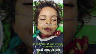 Focal Convulsions  Focal Seizures in a child [upl. by Lelith358]