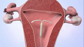 Patient Education Video Intrauterine Device IUD [upl. by Defant]