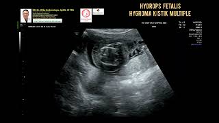 Hydrops Fetalis Hygroma Cystic [upl. by Adlar]