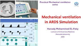 Simulation of Ventilator settings in ARDS in Arabic [upl. by Adnocahs]