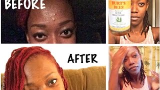 Burts Bees Natural Acne Solutions Review before and after [upl. by Lev438]