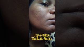 Day6 using Tretinoin Cream 0025 viralvideo skincare tretinoin shorts [upl. by Etnod]