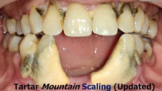 Tartar Removal from Teeth 😱Teeth whitening 😵‍💫I Mountain के जैसे पायरिया का इलाजI Dr Ram MDS [upl. by Grosz]