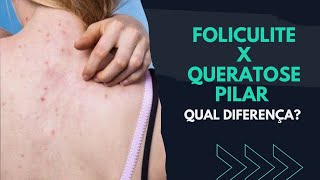 Foliculite x Queratose Pilar QUAL DIFERENÇA  DESCUBRA [upl. by Eatnhoj]