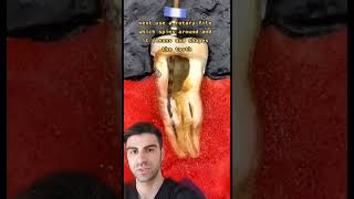 Root Canals Explained [upl. by Yaj]