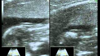 UltraSonografia 13 semanas  Morfológica TN  Alê e Airton [upl. by Ahsaeit]