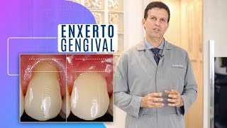 Enxerto gengiva o enxerto para diminuição de gengiva perdida na retração gengival [upl. by Bashemeth983]