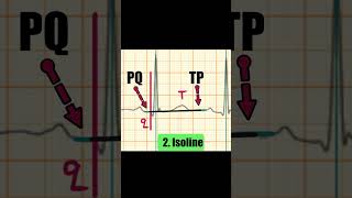 Accurate QT interval measurment by tangent method [upl. by Jacqueline]