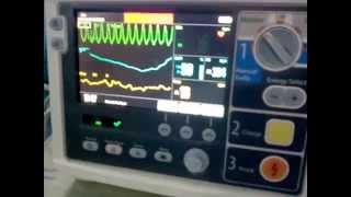 Ventricular Tachycardia in Cardiac Monitor [upl. by Enilrae204]