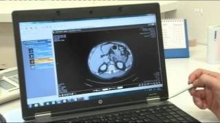 Pankreaskarzinom  Hirslanden amp Tele M1 Sendung „Gesundheitquot [upl. by Lucila]