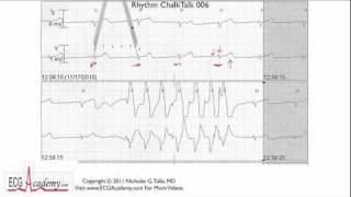 ECG Interpretation Tutorial  ChalkTalk 06  Basic Level [upl. by Gristede]